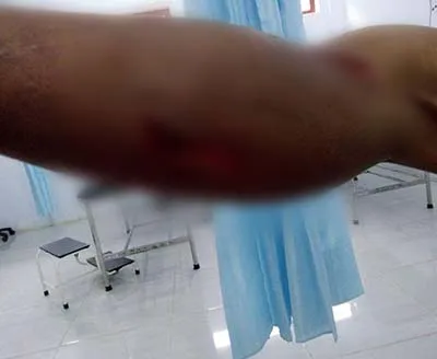 Terjatuh, Seorang Pekerja Masjid Al Imran Konsel Luka Parah