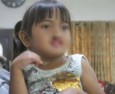 Antam UBPN Sultra Bantu Operasi 20 Anak Penderita Bibir Sumbing