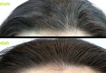 Uban Jadi Hitam Kembali Dalam Hitungan Menit Rambut beruban jadi hitam kembali