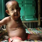 Kena Penyakit Aneh, Bocah 4 Tahun Terlihat Seperti Seorang Kakek Kena Penyakit Aneh, Bocah 4 Tahun Terlihat Seperti Seorang Kakek