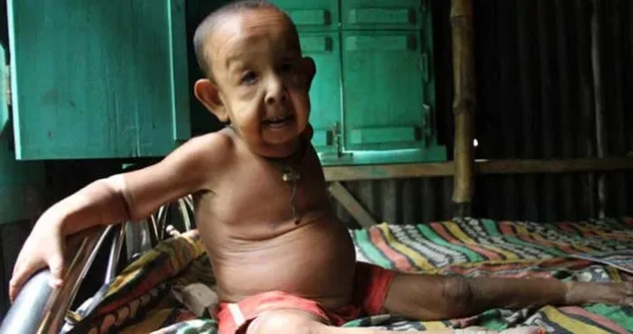 Kena Penyakit Aneh, Bocah 4 Tahun Terlihat Seperti Seorang Kakek