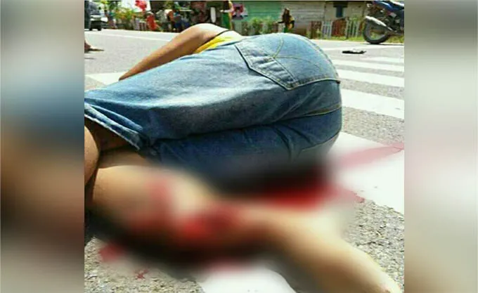 kecelakaan Ditabrak Saat Jemput Anak, Pria Ini Mengalami Patah Kaki