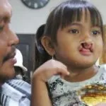 antam_bibir_sumbing_operasi1