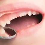 Kebiasaan Isap Ibu Jari Dapat Mengganggu Pertumbuhan Gigi Anak Ilustrasi