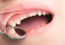 Kebiasaan Isap Ibu Jari Dapat Mengganggu Pertumbuhan Gigi Anak Ilustrasi