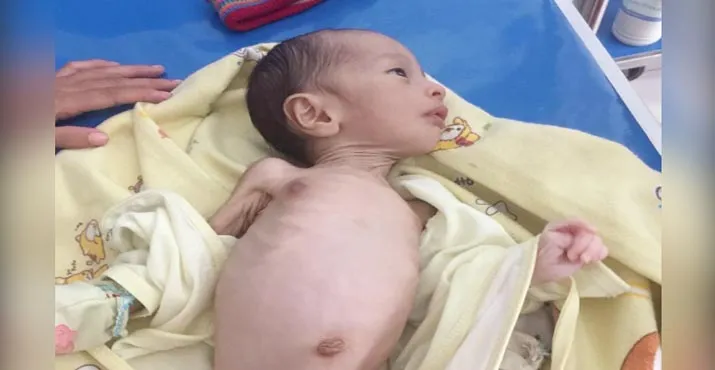 Bayi Penderita Gizi Buruk Ini Terbaling Lemah di RSUD Kolut