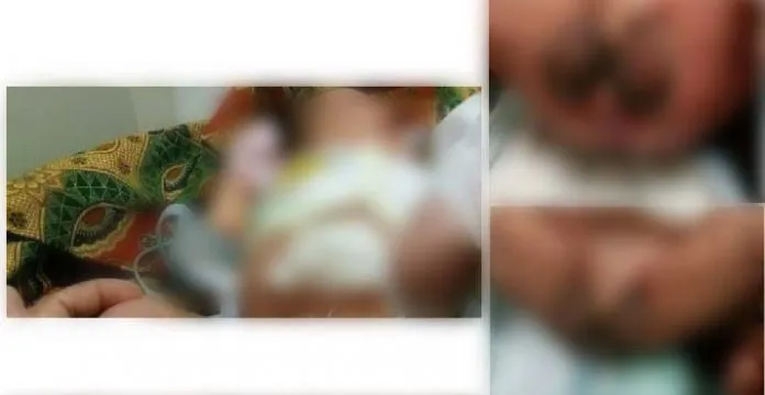 Lahir Tanpa Anus, Bayi Asal Koltim Dirawat di RSUD Bahteramas