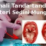 Penyakit Difteri Landa Sultra, Ini Saran Kadinkes Konut ilustrasi difteri