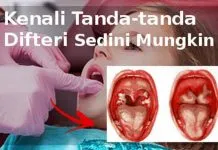 Sweeping Imunisasi, Upaya Dinkes Konawe Cegah Difteri ilustrasi difteri