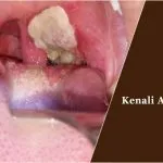 Kenali Apa Itu Difteri ilustrasi difteri