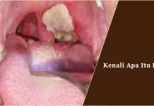 Kenali Apa Itu Difteri ilustrasi difteri