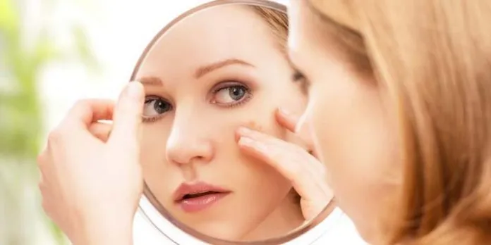 ilustrasi jerawat Jerawat Membandel, Berikut Lima Jenis Perawatan Murah Bisa Jadi Solusi