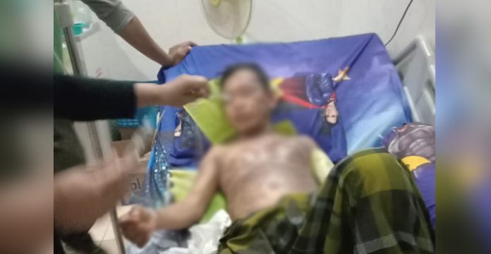 Sakit Hati, Seorang Istri di Konsel Tega Menyiram Suaminya dengan Air Mendidih