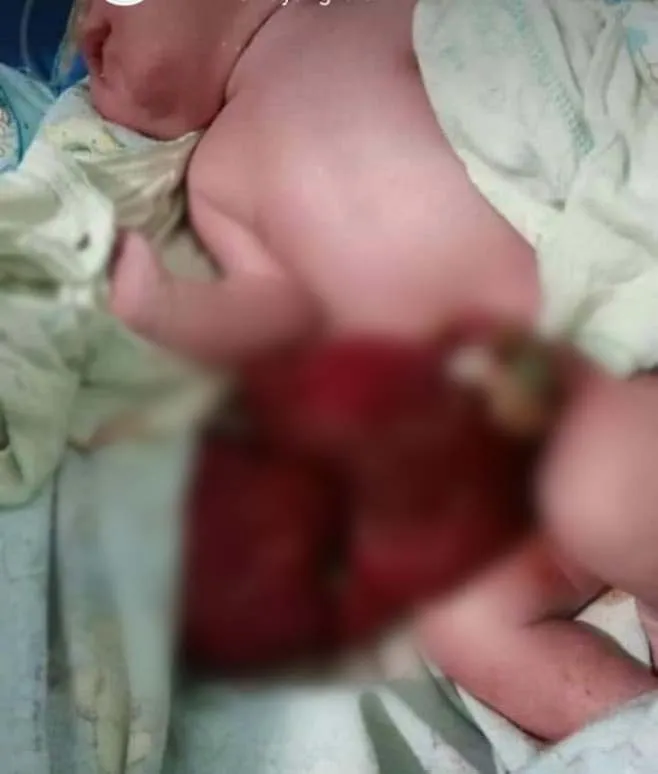 Usus Keluar dan Gizi Buruk, Dua Bayi di RSUD Bombana Kritis