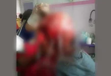 Rambut Terlilit Baling-baling Kapal, Kulit Kepala Remaja di Konut Terkelupas Rambut Terlilit Baling-baling Kapal, Kulit Kepala Remaja di Konut Terkelupas