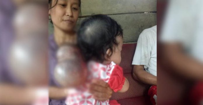 Alami Pembengkakkan Kepala, Seorang Bayi di Konsel Butuh Bantuan