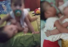 Kondisi Kian Membaik, Bayi Kembar Aqila Azila Akan Pulang Besok Kembar Siam di Kendari Aqila-Azila Tak Kunjung Dioperasi