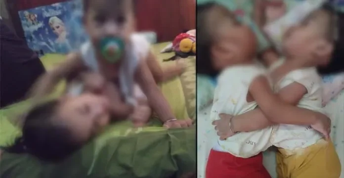 Kembar Siam di Kendari Aqila-Azila Tak Kunjung Dioperasi