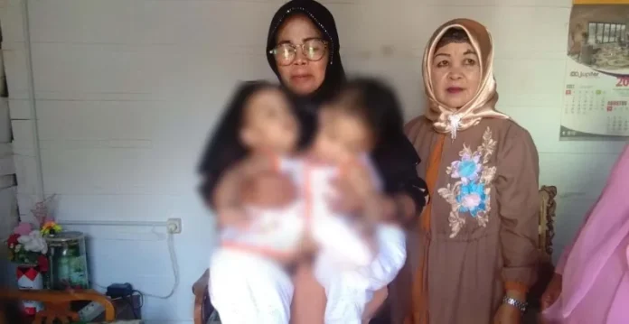 Bayi Kembar Siam Asal Kendari Ini Akan Dioperasi di Surabaya
