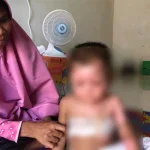 Kisah Mikaila, Balita di Kendari yang Tersiram Air Panas Kisah Mikaila, Balita di Kendari yang Tersiram Air Panas