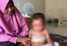 Kisah Mikaila, Balita di Kendari yang Tersiram Air Panas Kisah Mikaila, Balita di Kendari yang Tersiram Air Panas