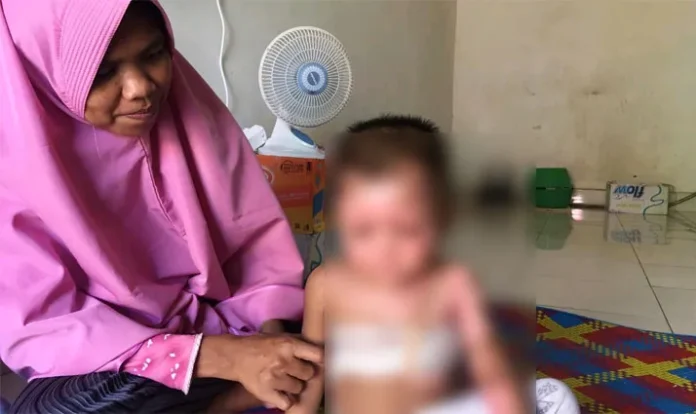 Kisah Mikaila, Balita di Kendari yang Tersiram Air Panas