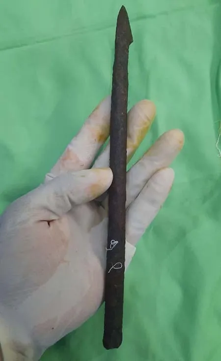 Batang Besi yang Tertancap di Dada Pemuda Wakatobi Berhasil Dicabut