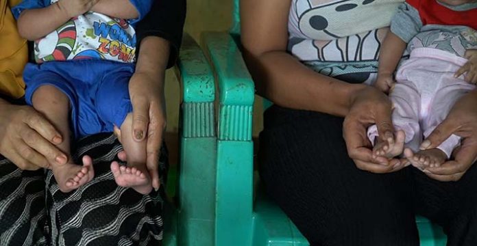 Bayi Kembar di Baubau Lahir dengan 12 Jari Kaki