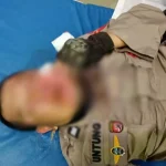Patah Tulang di Wajah, Dua Polisi Korban Kerusuhan Bakal Dioperasi