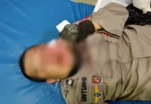 Patah Tulang di Wajah, Dua Polisi Korban Kerusuhan Bakal Dioperasi