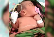 Lahir Tanpa Anus, Bayi Perempuan di Muna Butuh Uluran Tangan Lahir Tanpa Anus, Bayi Perempuan di Muna Butuh Uluran Tangan
