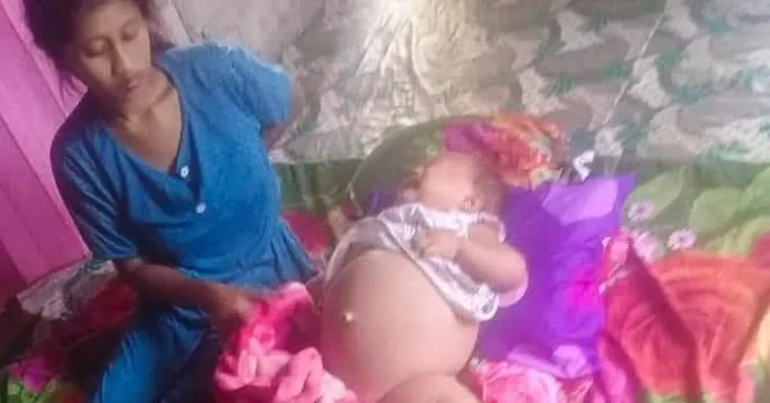 Balita Penderita Ginjal Bocor di Mubar Butuh Uluran Tangan