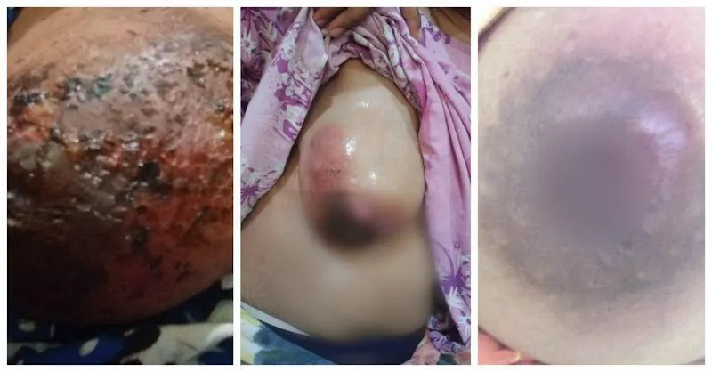 Cerita Bainun, Pengidap Kanker Payudara yang Sembuh Total Berkat Olahan Kelor Buatannya