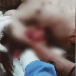 Tangan Seorang Warga di Mubar Nyaris Putus Usai Diterkam Buaya Tangan Seorang Warga di Mubar Nyaris Putus Usai Diterkam Buaya